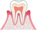 軽度歯周炎