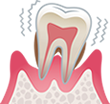 重度歯周炎