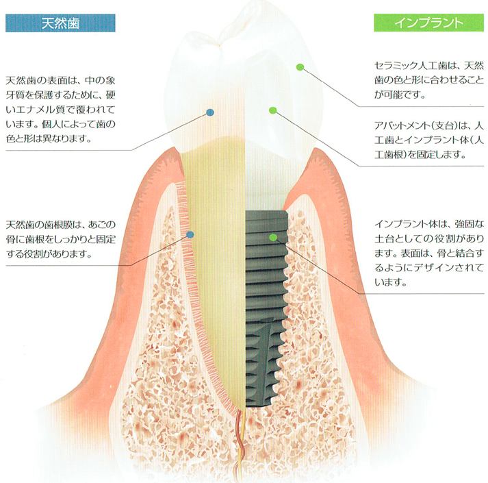 インプラント模型