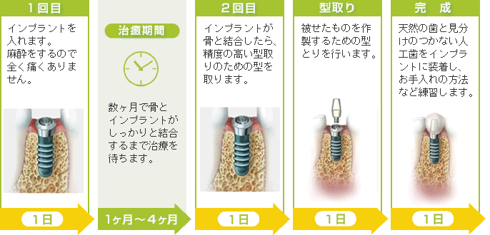 インプラント埋め込みから完成まで