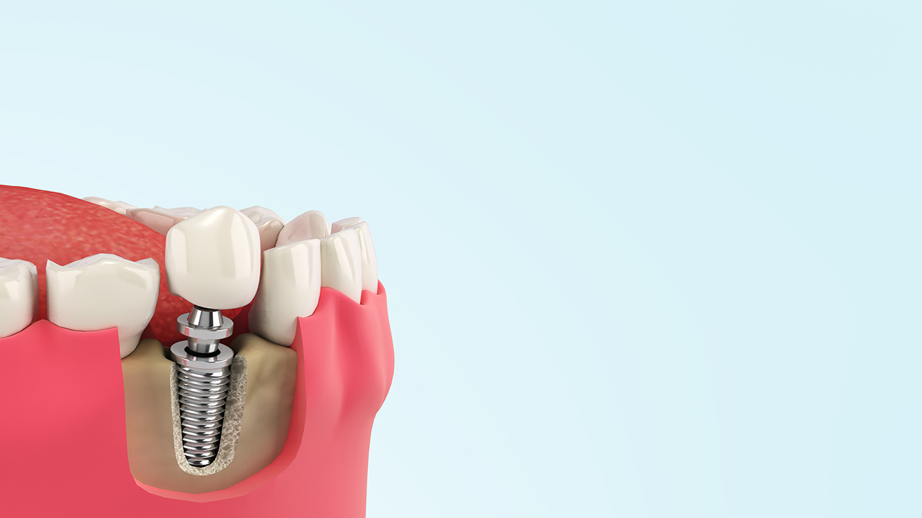 入れ歯とインプラントのメンテナンス