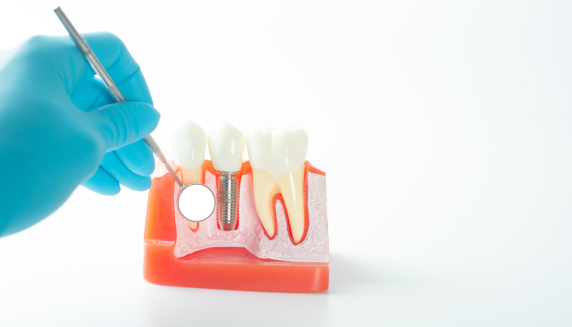 インプラント治療後は歯茎のトラブルに注意！歯茎が下がる・黒くなる原因や予防法も解説